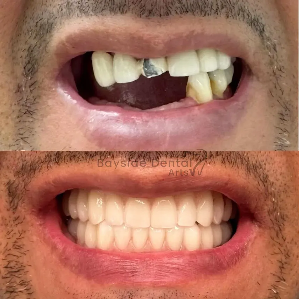 Bayside Dental Arts before and after full mouth restoration with implants and whitening