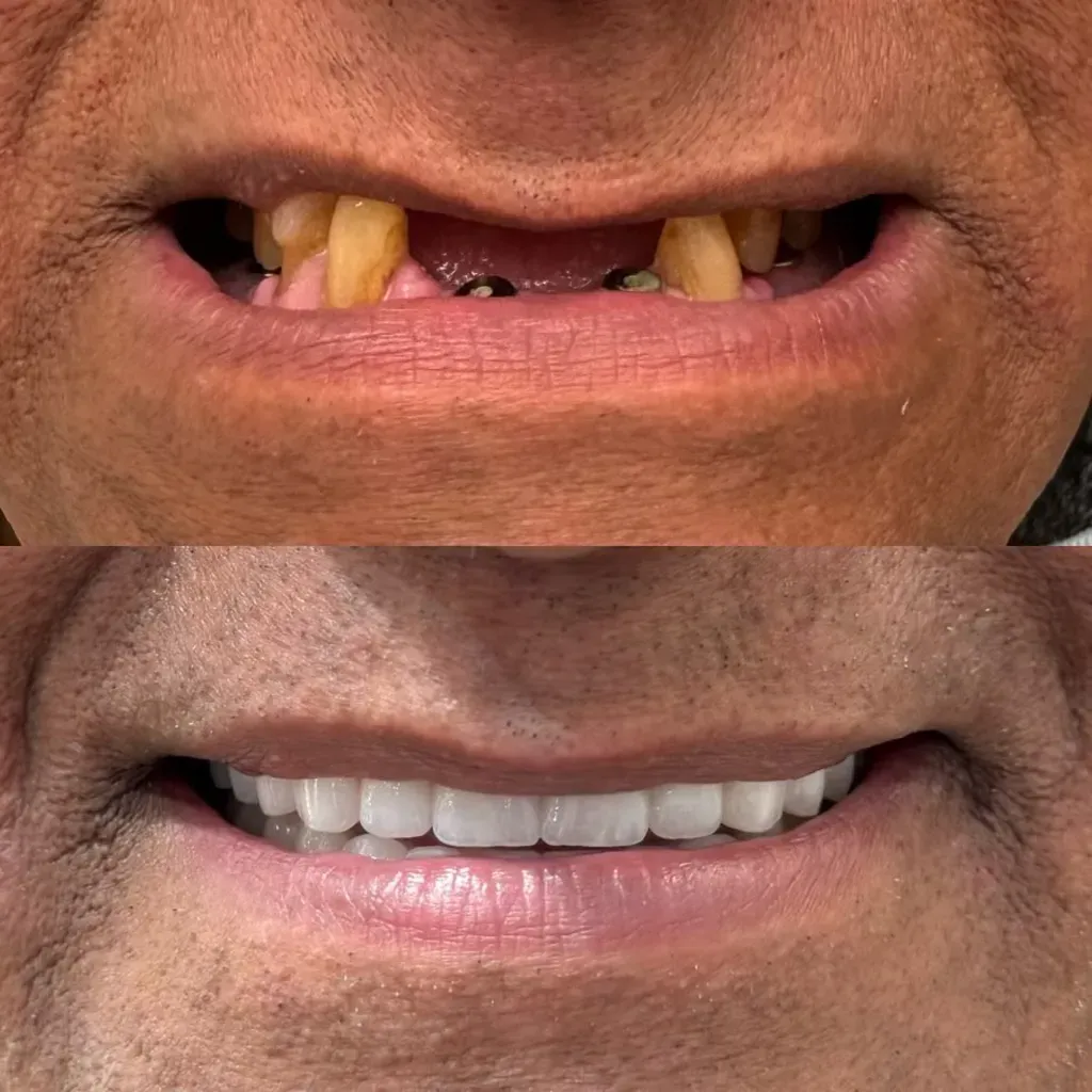 Before and after smile restoration showing tooth replacement and whitening results