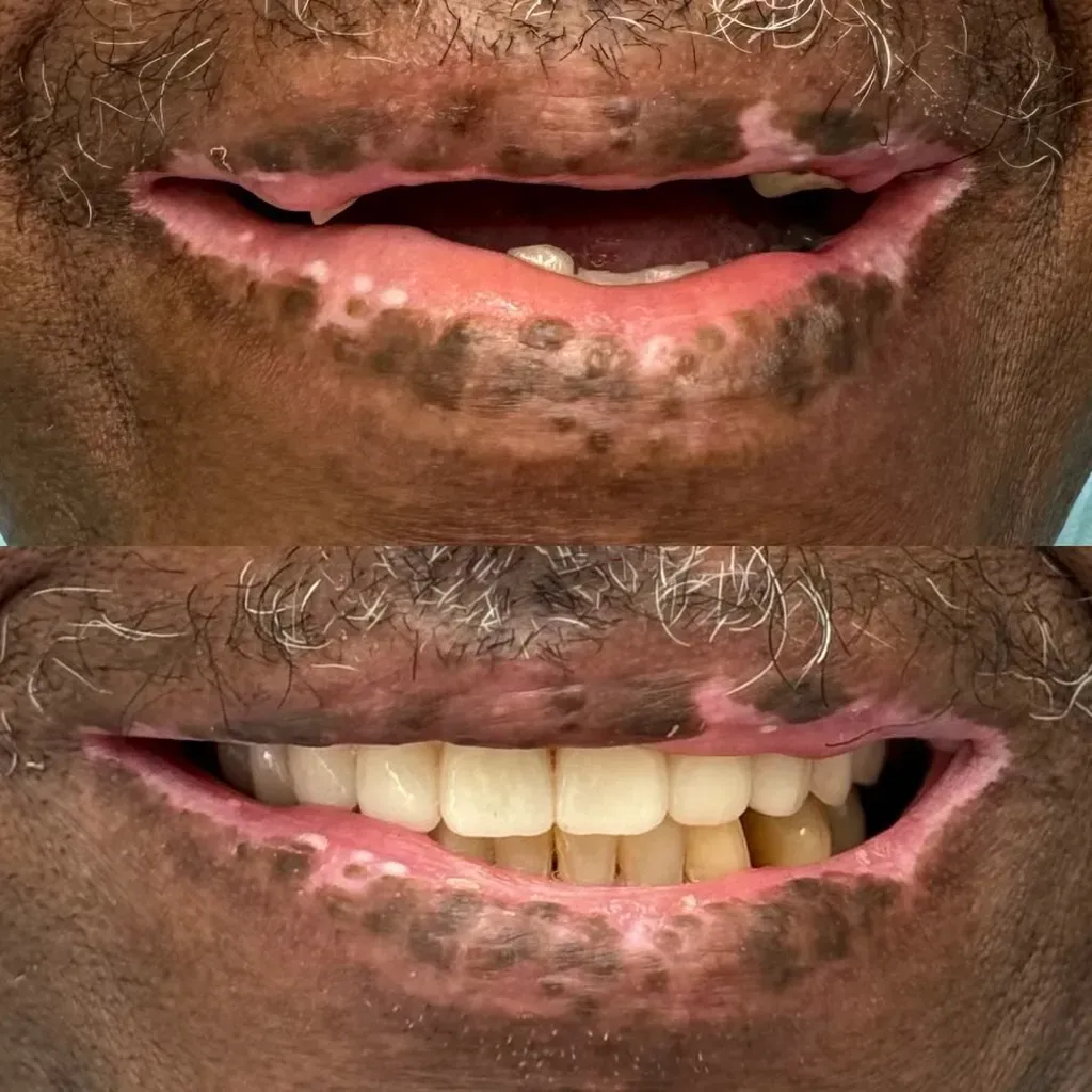 Before and after full mouth dental restoration showing complete smile transformation