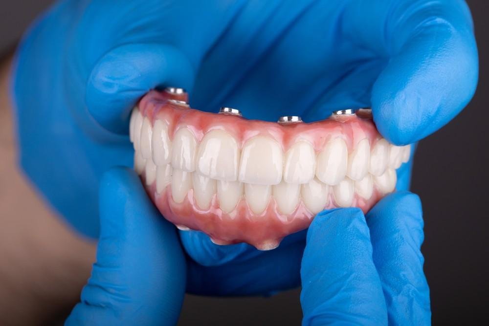 Implant-supported dentures and bridges at Bayside Dental Arts in Queens, NY