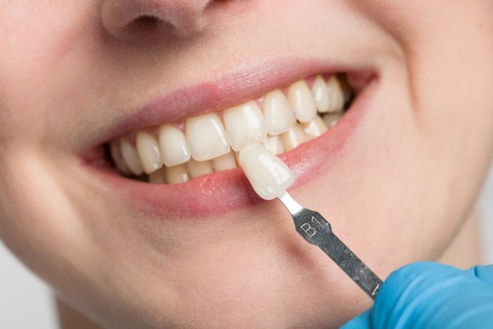 Porcelain veneers smile makeover at Bayside Dental Arts in Queens