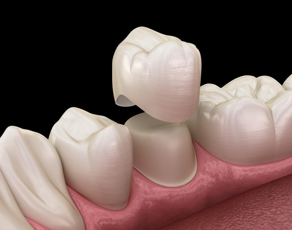 Caring for a temporary dental crown at Bayside Dental Arts