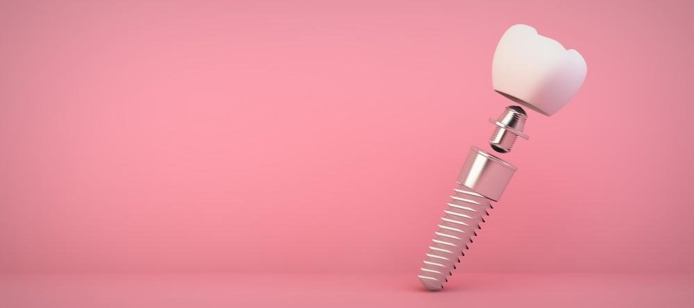 Full mouth vs single tooth dental implants at Bayside Dental Arts