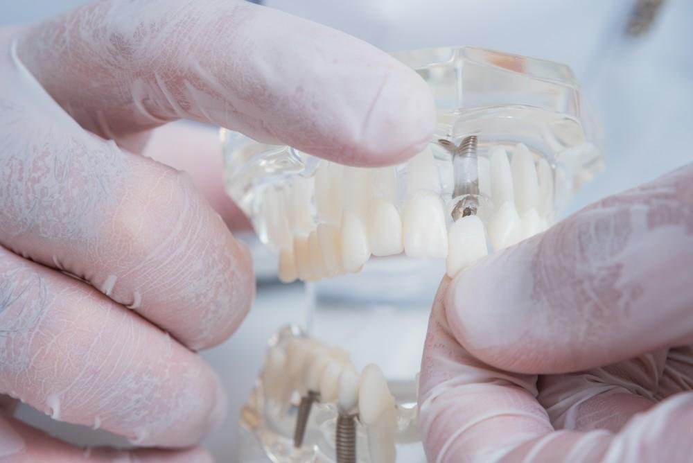 Dentures vs dental implants comparison at Bayside Dental Arts