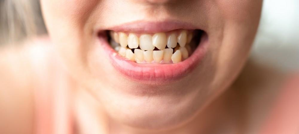 Veneers for crooked teeth at Bayside Dental Arts in Queens