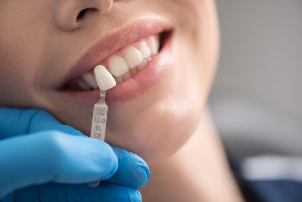 Steps to take with a loose dental crown - Bayside Dental Arts