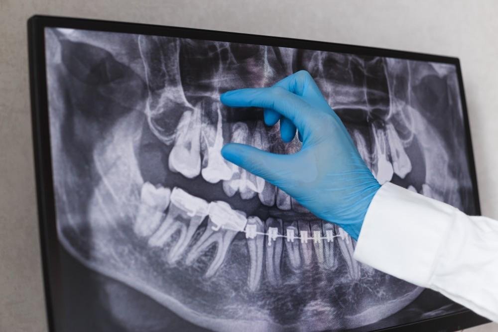 Caring for a temporary crown after a root canal - Bayside Dental Arts